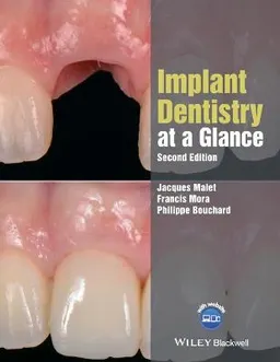 Implant Dentistry at a Glance [Elektronisk resurs]; Jacques Malet, Francis Mora, Philippe Bouchard; 2018