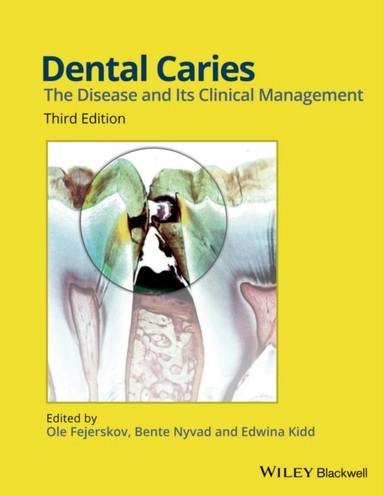 Dental Caries: The Disease and its Clinical Management; Ole Fejerskov, Bente Nyvad, Edwina Kidd; 2015