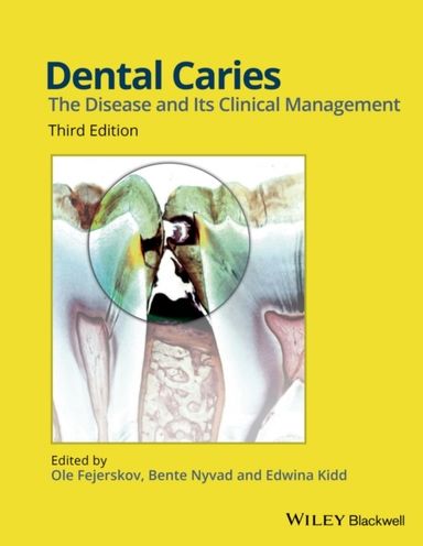 Dental Caries: The Disease and its Clinical Management