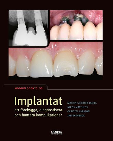 Implantat : att förebygga, diagnostisera och hantera komplikationer